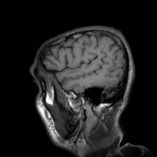File:Central-variant posterior reversible encephalopathy syndrome (PRES) (Radiopaedia 43880-47359 Sagittal T1 21).jpg