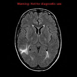 File:Central nervous system vasculitis (Radiopaedia 8410-9235 Axial FLAIR 13).jpg