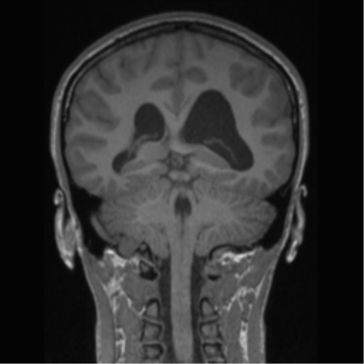 Central neurocytoma (Radiopaedia 37664-39557 Coronal T1 34).png
