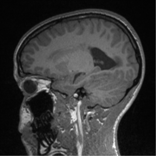 Central neurocytoma (Radiopaedia 37664-39557 Sagittal T1 64).png