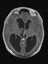 Central neurocytoma (Radiopaedia 56690-63469 Axial T1 C+ 78).jpg