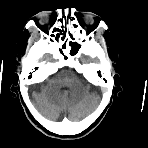 File:Central neurocytoma (Radiopaedia 65317-74346 Axial non-contrast 13).png