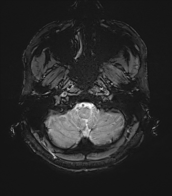 Central neurocytoma (Radiopaedia 71068-81303 Axial SWI 1).jpg