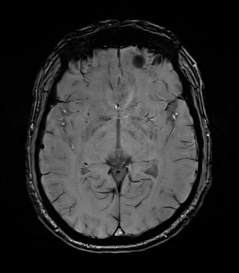 Central neurocytoma (Radiopaedia 71068-81303 Axial SWI 29).jpg