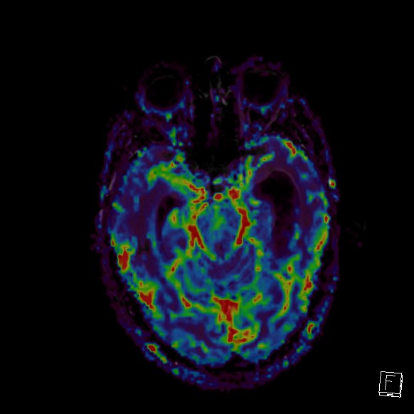 Central neurocytoma (Radiopaedia 84497-99872 Axial Perfusion 207).jpg