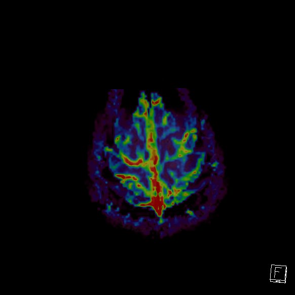 Central neurocytoma (Radiopaedia 84497-99872 Axial Perfusion 23).jpg
