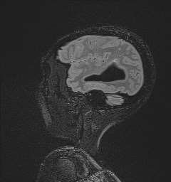 Central neurocytoma (Radiopaedia 84497-99872 Sagittal Flair + Gd 124).jpg