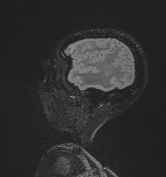 File:Central neurocytoma (Radiopaedia 84497-99872 Sagittal Flair + Gd 129).jpg