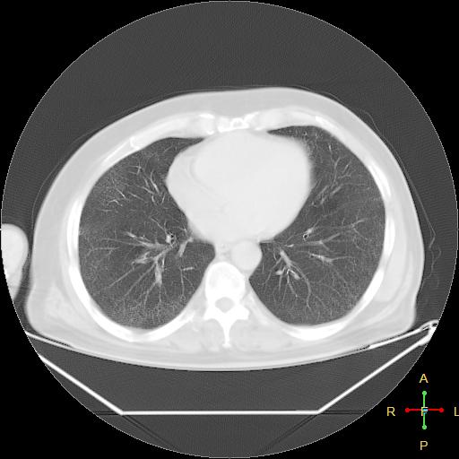 File:Centrilobular emphysema - with superimposed infection (Radiopaedia 24389-24683 lung window 19).jpg