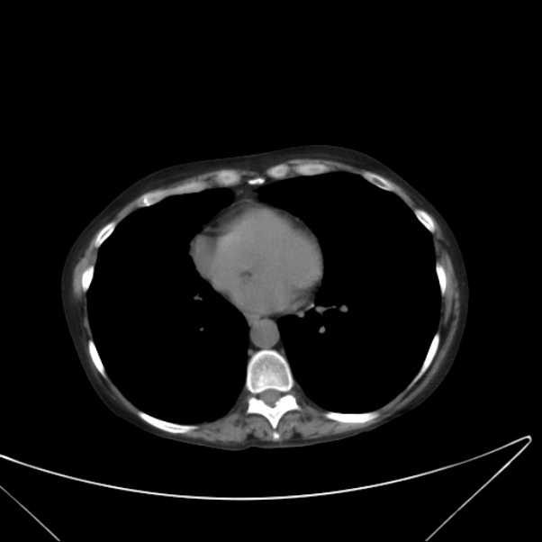 Centrilobular pulmonary emphysema (Radiopaedia 24495-24789 Axial non-contrast 32).jpg