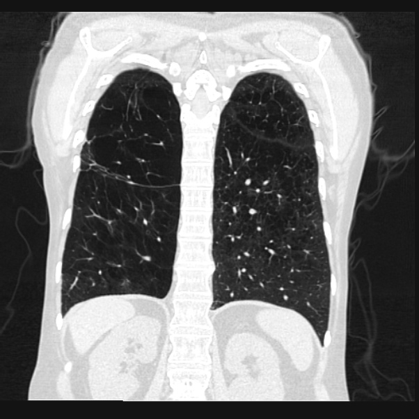 Centrilobular pulmonary emphysema (Radiopaedia 24495-24789 Coronal lung window 57).jpg