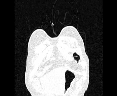 Centrilobular pulmonary emphysema (Radiopaedia 62468-70718 Coronal lung window 5).jpg