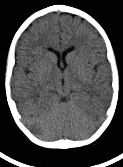 Cerebellar abscess (Radiopaedia 73727-84527 Axial non-contrast 37).jpg