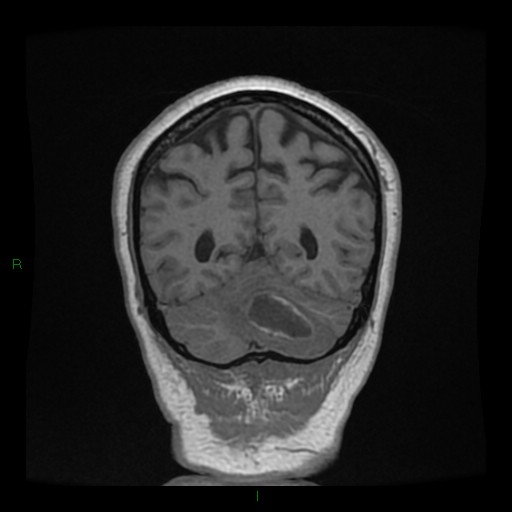 File:Cerebellar abscess (Radiopaedia 78135-90678 Coronal T1 C+ 127).jpg