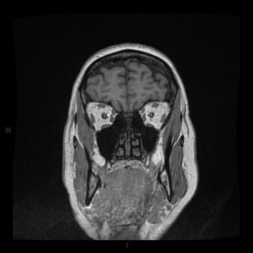 Cerebellar abscess (Radiopaedia 78135-90678 Coronal T1 C+ 29).jpg