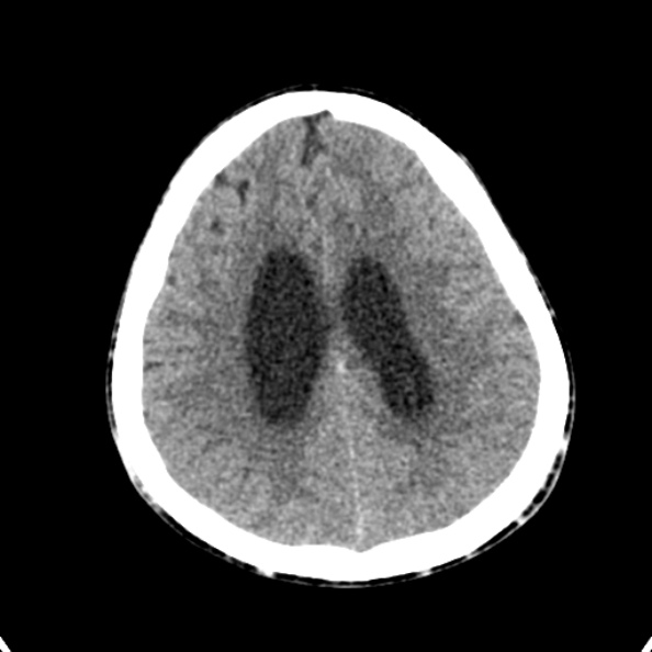 Cerebellar abscess secondary to mastoiditis (Radiopaedia 26284-26412 Axial non-contrast 117).jpg