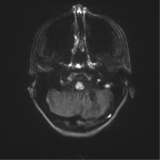 Cerebellar agenesis with hypoplastic pons (pontocerebellar hypoplasia) (Radiopaedia 57224-64138 Axial DWI 44).png