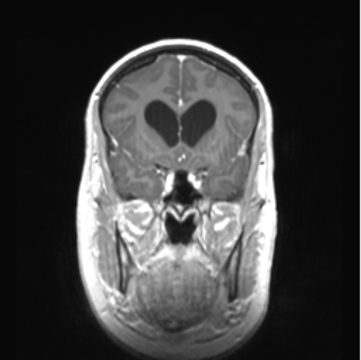 Cerebellar ependymoma complicated by post-operative subdural hematoma (Radiopaedia 83322-97736 Coronal T1 C+ 19).png