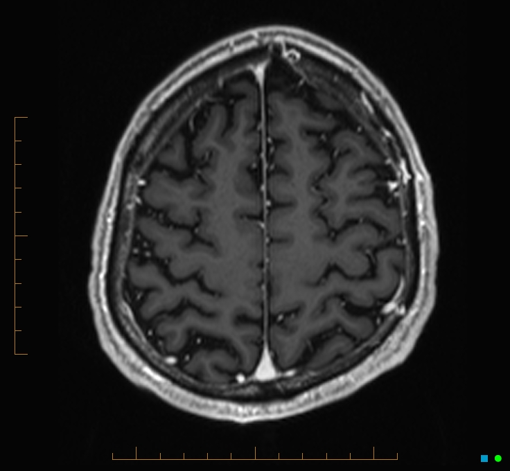 Cerebellar gangliocytoma (Radiopaedia 65377-74422 Axial T1 C+ 115).jpg