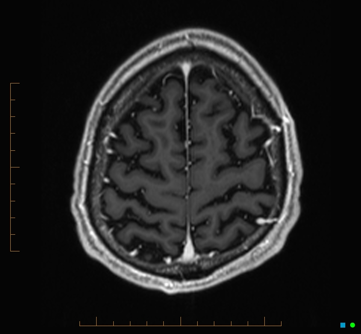 Cerebellar gangliocytoma (Radiopaedia 65377-74422 Axial T1 C+ 122).jpg
