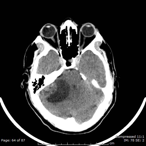 Cerebellar hemangioblastoma (Radiopaedia 52360-58258 Axial non-contrast 64).jpg