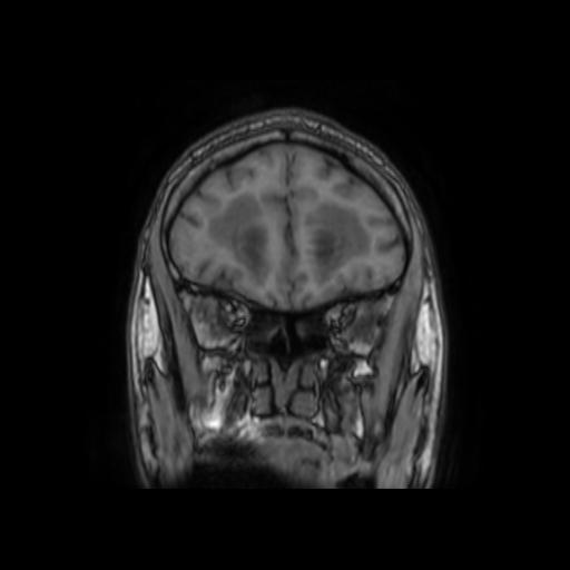 File:Cerebellar hemangioblastoma (Radiopaedia 88055-104622 Coronal T1 10).jpg