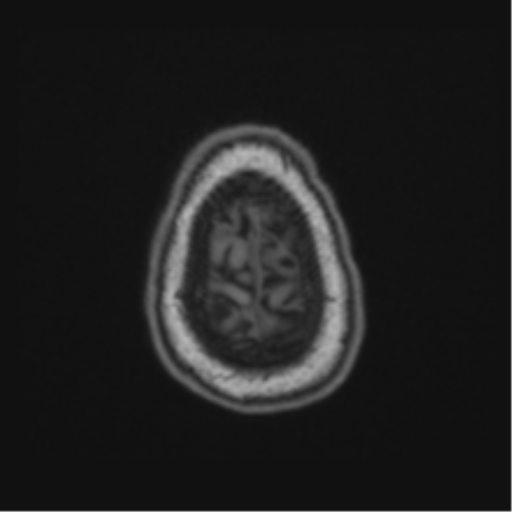 Cerebellar hemangioblastomas and pituitary adenoma (Radiopaedia 85490-101176 Axial T1 68).png