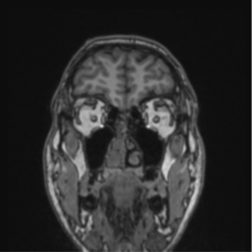 File:Cerebellar hemangioblastomas and pituitary adenoma (Radiopaedia 85490-101176 Coronal T1 75).png