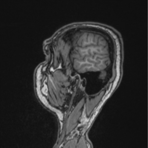 File:Cerebellar hemangioblastomas and pituitary adenoma (Radiopaedia 85490-101176 Sagittal T1 80).png