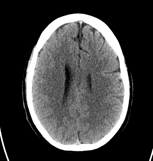 File:Cerebellar infarct due to vertebral artery dissection with posterior fossa decompression (Radiopaedia 82779-97031 Axial non-contrast 21).png