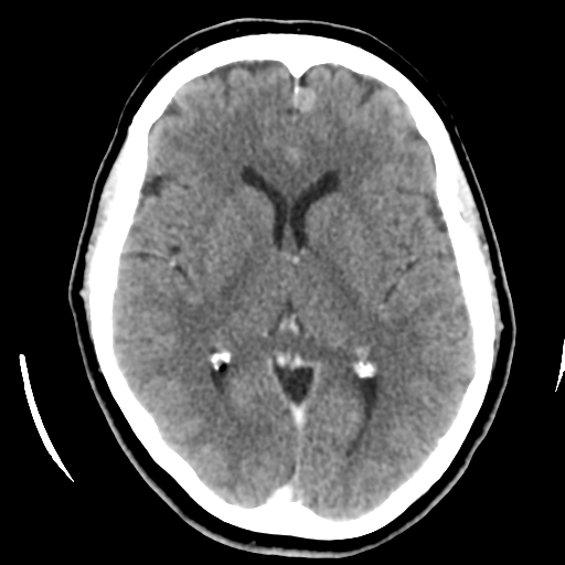 File:Cerebellar metastasis (cystic appearance) (Radiopaedia 41395-44258 B 26).png