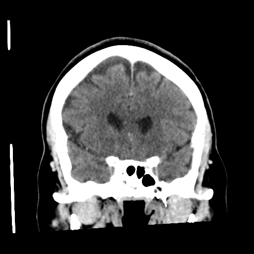 Cerebellar metastasis (cystic appearance) (Radiopaedia 41395-44258 D 24).png