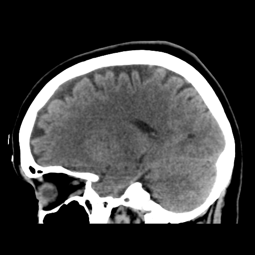 Cerebellar metastasis (cystic appearance) (Radiopaedia 41395-44258 E 23).png