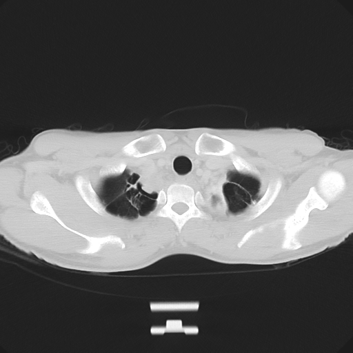 Cerebellar metastasis - adenocarcinoma lung (Radiopaedia 63184-71717 Axial lung window 10).png