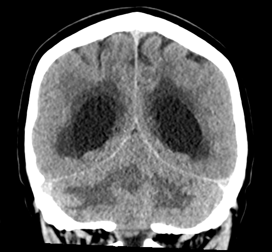 File:Cerebellar metastasis from lung adenocarcinoma (Radiopaedia 86690-102828 Coronal non-contrast 28).png
