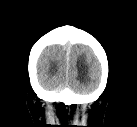 File:Cerebellar metastasis from lung adenocarcinoma (Radiopaedia 86690-102828 Coronal non-contrast 37).png
