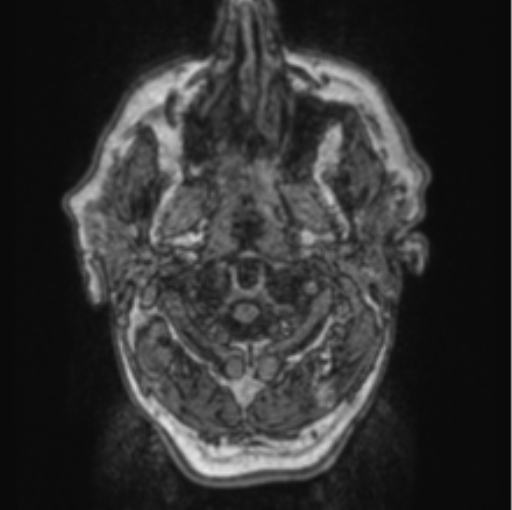Cerebellar metastasis from lung adenocarcinoma (Radiopaedia 86690-102829 Axial T1 2).png