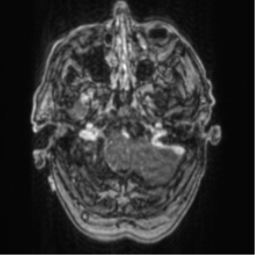 Cerebellar metastasis from lung adenocarcinoma (Radiopaedia 86690-102829 Axial T1 C+ 14).png