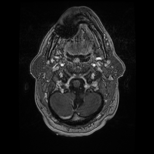File:Cerebellar metastasis of pulmonary adenocarcinoma, cavernous venous malformation, and developmental venous anomaly (Radiopaedia 85827-101661 Axial T1 C+ 13).jpg