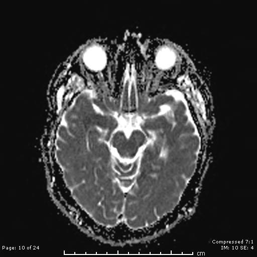 File:Cerebellar strokes due to intracranial giant cell arteritis (Radiopaedia 68799-81713 Axial ADC 10).jpg