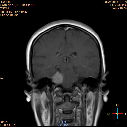 File:Cerebellopontine angle meningioma (Radiopaedia 22488-22525 Coronal T1 C+ 11).jpg