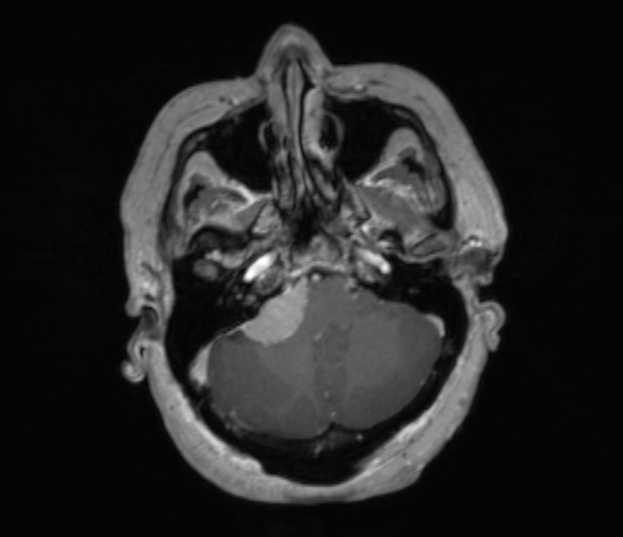 Cerebellopontine angle meningioma (Radiopaedia 35181-36715 Axial T1 C+ 43).jpg