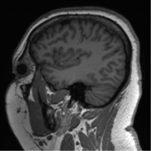 Cerebellopontine angle meningioma (Radiopaedia 48434-53348 Sagittal T1 68).png