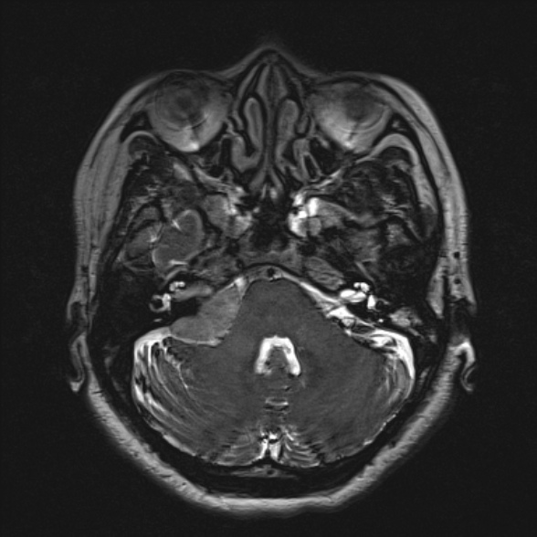 Cerebellopontine angle meningioma (Radiopaedia 53561-59591 Axial 3D volume T2 56).jpg