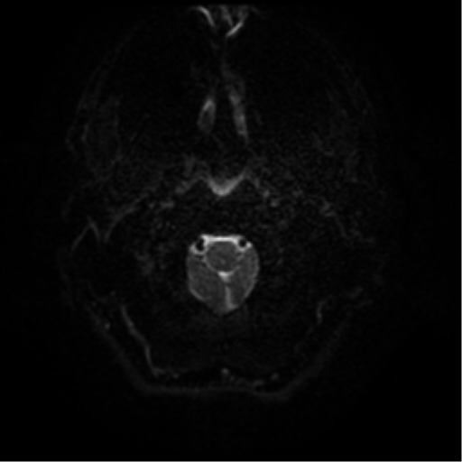 File:Cerebral abscess (Radiopaedia 57774-64740 Axial DWI 30).png