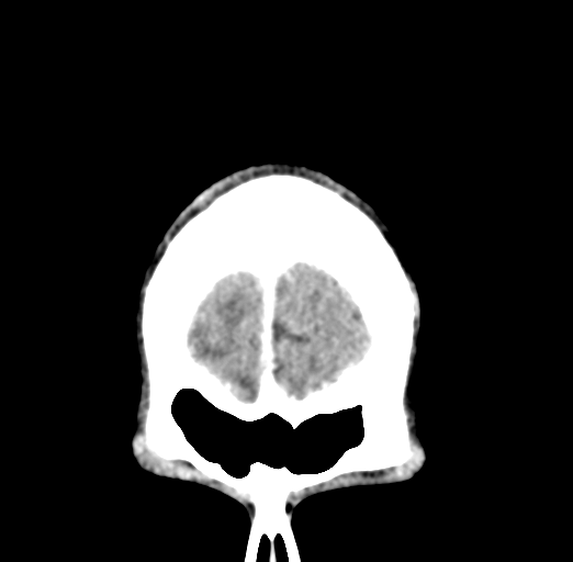 Cerebral abscess (Radiopaedia 60342-68008 Coronal C+ delayed 6).png