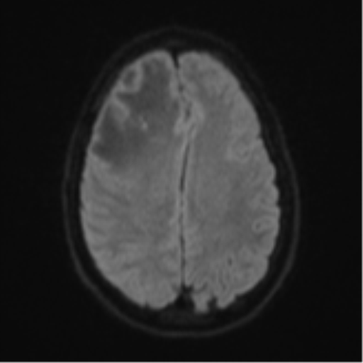 File:Cerebral abscess (Radiopaedia 60342-68009 Axial DWI 61).png