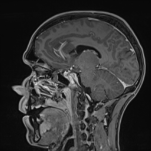 Cerebral abscess (Radiopaedia 60342-68009 J 26).png