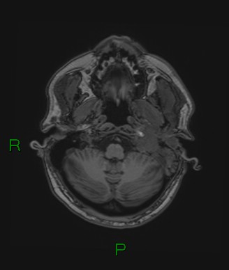 Cerebral abscess and subdural empyema (Radiopaedia 84436-99779 Axial T1 71).jpg