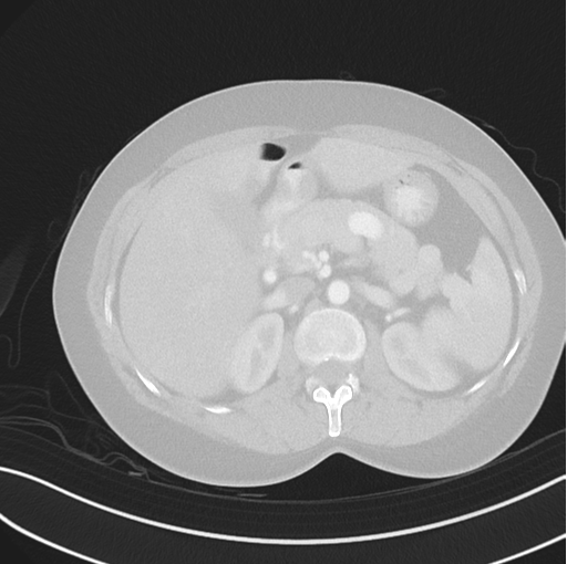 File:Cerebral abscess from pulmonary arteriovenous malformation (Radiopaedia 86275-102292 Axial lung window 67).png